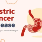 Plantillas PowerPoint de Cáncer Gástrico