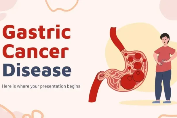 Plantillas PowerPoint de Cáncer Gástrico